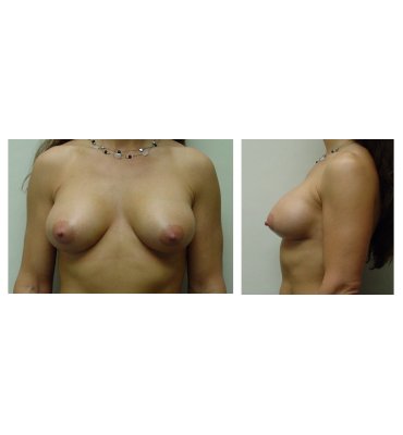 Breast Lift Without Scars After